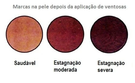 Imagem demonstrando marcas na pele após aplicação de ventosas, variando de saudável a estagnação severa, destacando a importância de cuidados dermatológicos.