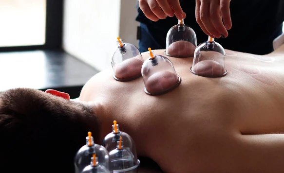 Sessão de sessões de terapia de ventos com copos de ventosas sobre as costas de uma pessoa, promovendo relaxamento e bem-estar.