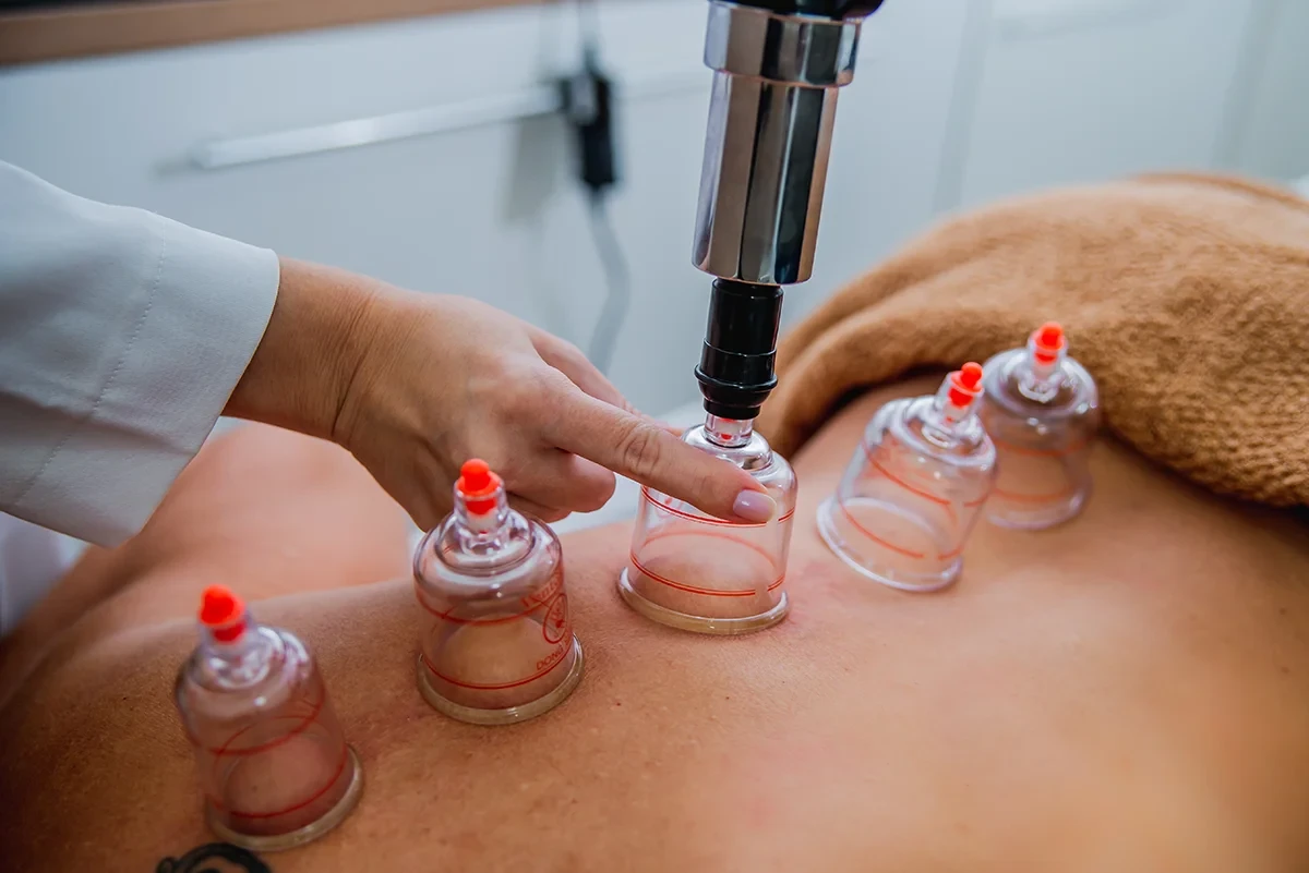 Sessão de ventosoterapia no tratamento terapêutico de cuidados com a pele, usando ventosas em uma pessoa para melhorar circulação e bem-estar.